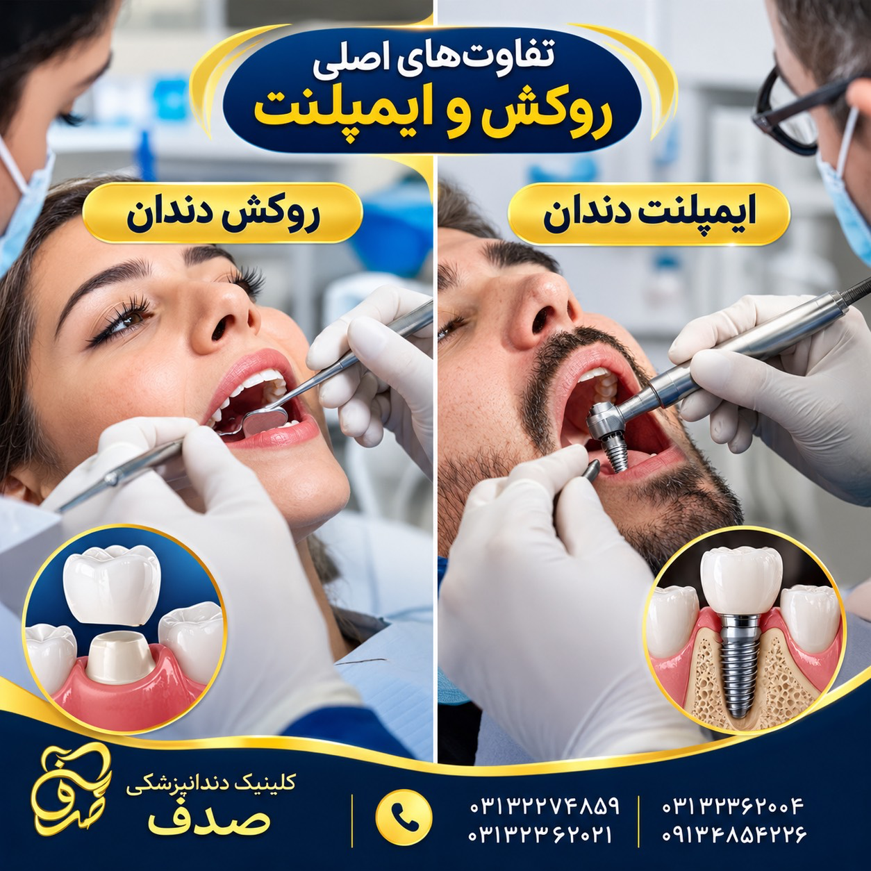 تفاوت‌های اصلی روکش و ایمپلنت