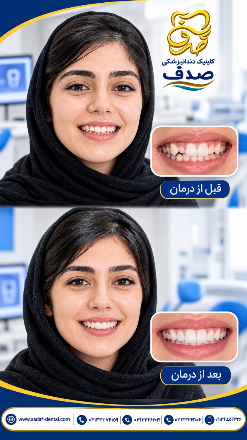 قبل و بعد مراحل ارتودنسی دندان