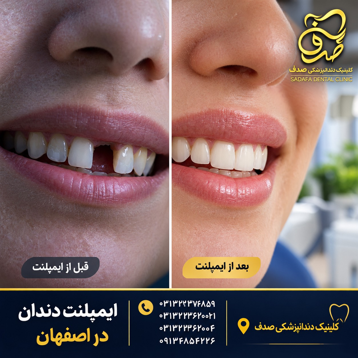 دکتر ایمپلنت اصفهان